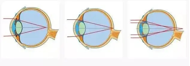 Testing Equipment for Complications of High Myopia